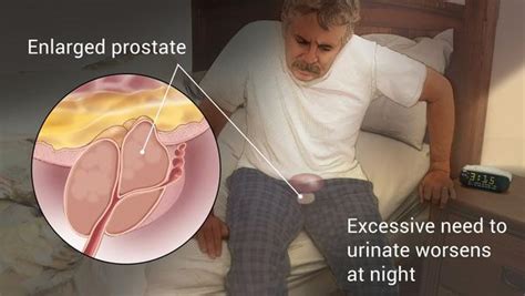 Benign Prostatic Hyperplasia How To Guide Tips And Tricks