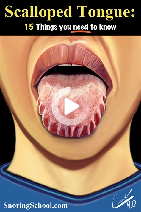 Scalloped Tongue Things You Need To Know Tongue Health Tongue Sores