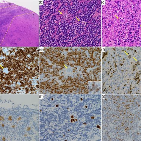 Histology Of Mantle Cell Lymphoma Mcl Composite With Epstein Barr