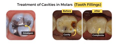 Cavities In Molars Symptoms Causes And Treatment Share Dental Care