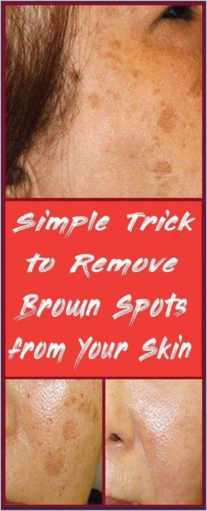 Simple Trick To Remove Brown Spots From Your Skin Healthy Beat In