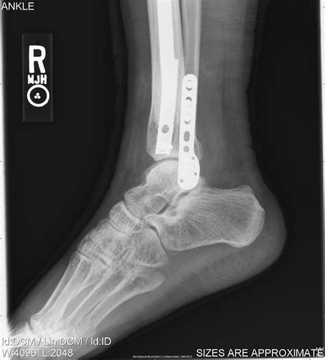 Broken Ankle After Surgery Flickr Photo Sharing