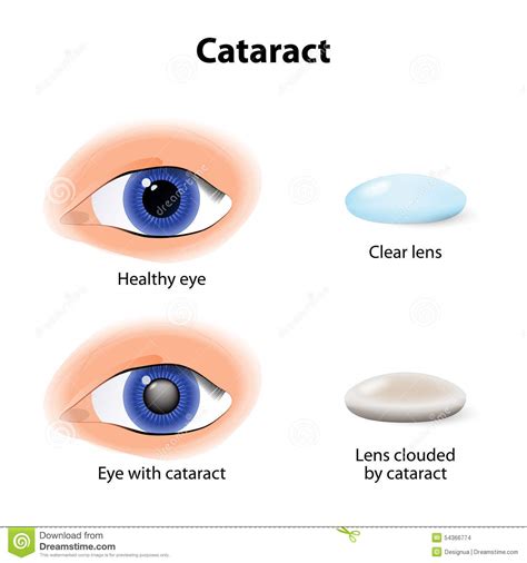 Une Cataracte Est Un Cristallin De Opacification Illustration de ...