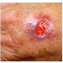 Ulcer Skin