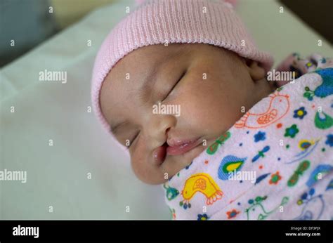Newborn Baby With Cleft Lip And Palate Sleeping Stock Photo Alamy