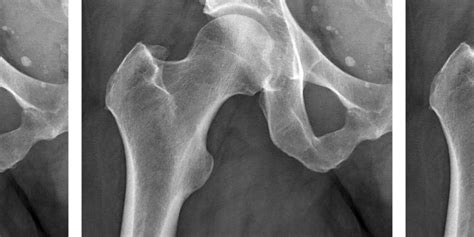 Hip Joint Space Width Type Of Radiograph Irrelevant Orthopedics