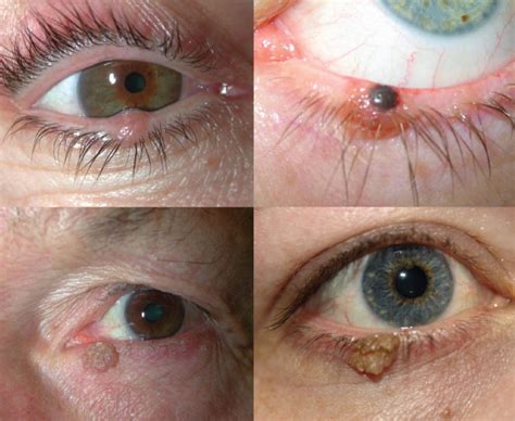 Eyelid Lesions For Medical Students عيادات السالم لطب و جراحة العين