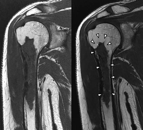 The Mri Appearances Of Cancellous Allograft Bone Chips After The