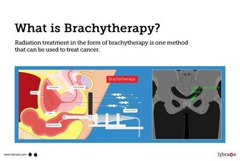 Brachytherapy Causes Symptoms Treatment And Cost