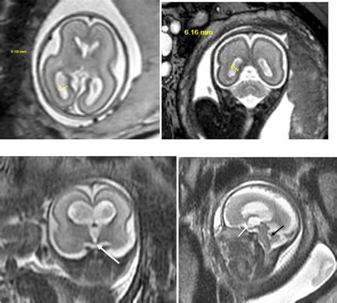 Axial T2 Ssfse Image From Fetal Mri Through The Brain Of A 23 Week