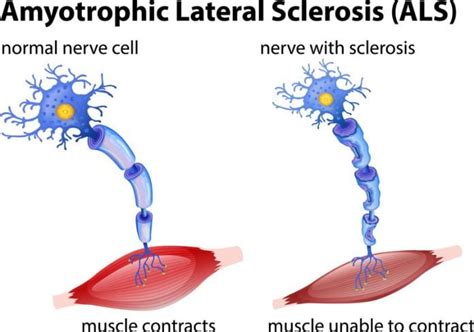 Short for amyotrophic lateral sclerosis, otherwise known as lou gehrig's disease. Amyotrophic lateral sclerosis (ALS) - Symptoms and causes