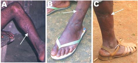 Figure 3 - Simian Foamy Virus Transmission from Apes to Humans, Rural