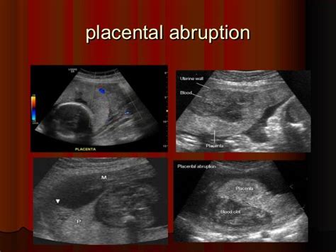 Placenta Positions On Ultrasound