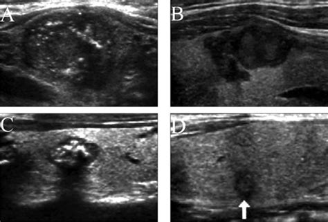 Medullary Carcinoma Thyroid Ultrasound