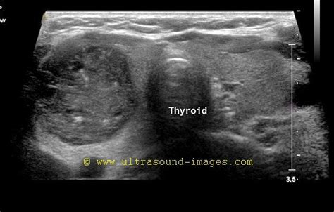 The role of sonography in thyroid cancer. WK 1 THYROID Biopsy proven papillary carcinoma of thyroid ...