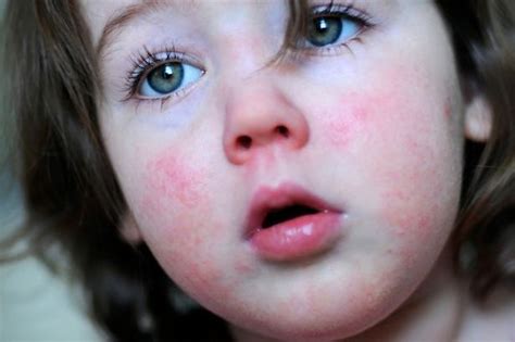 What You Need To Know About Scarlet Fever First Aid Pro Brisbane