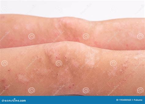 Manifestation Of Dermatitis On The Child Body Rash On The Legs Close
