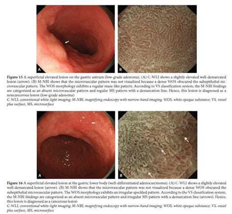 The Endoscopic Diagnosis Of Early Gastric Cancer Yao Annals Of