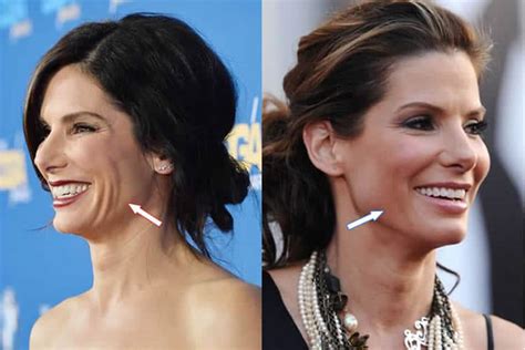 Has Sandra Bullock Had Plastic Surgery Before And After Photos