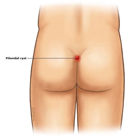Gluteal Fold Best Adult Videos And Photos