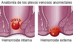 Hemorroides enfermedades del ano fotos. Alimentos para combatir las hemorroides