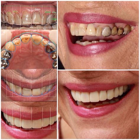 Diseño De Sonrisa Odontología Estetica Implantes Dentales Estetica