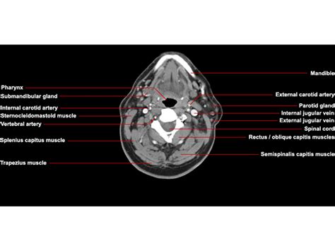 Ct Neck Axial Anatomy Radiologypicscom