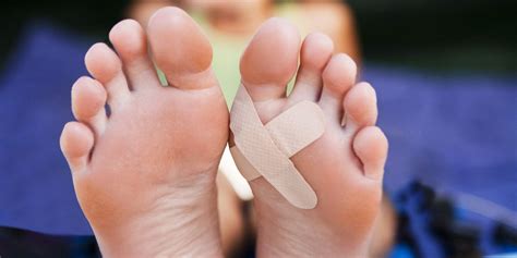 Blisters On Feet Treatment And Prevention Tips