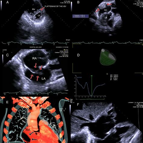 A Transthoracic Echocardiography Tte Image Showing Marked