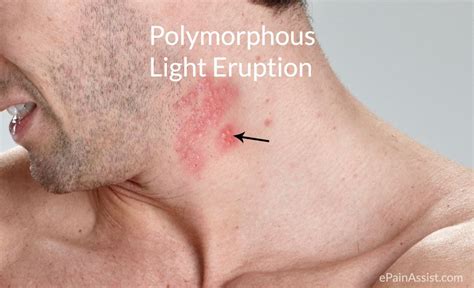Polymorphous Light Eruption Ple Or Polymorphic Light Eruption Pmle