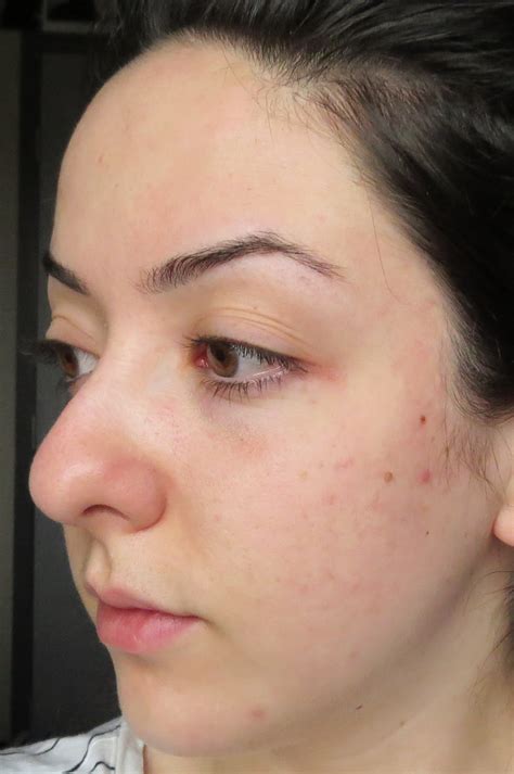 My Skins Journey Week 36 Banish Acne Scars