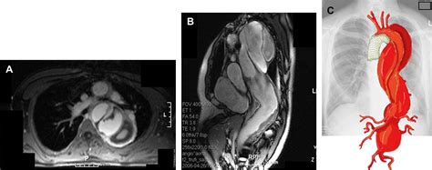 Total Thoracoabdominal Aortic Replacement In A Marfan Patient Following