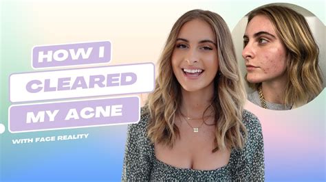 My Experience With The Face Reality Acne Program Youtube
