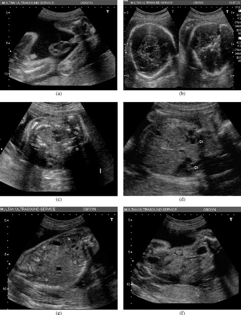 Figure 2 From Ultrasound Diagnosis Of Cephalopagus Conjoined Twin