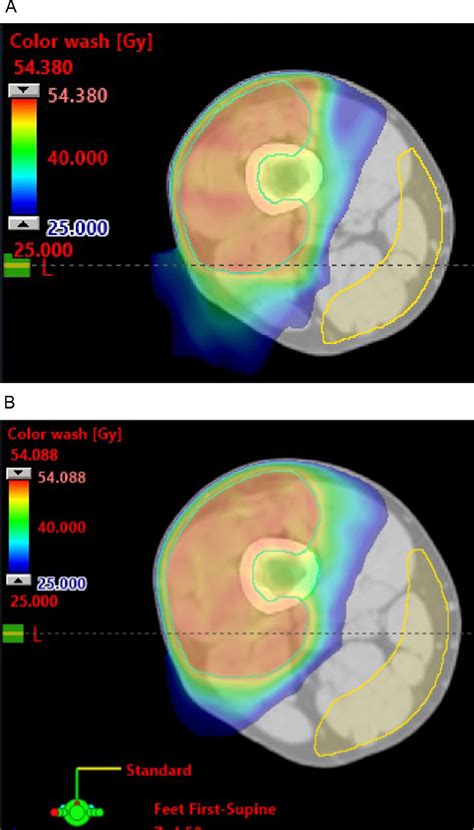 Dosimetric Comparison Of Volumetric Modulated Arc Therapy And Intensity