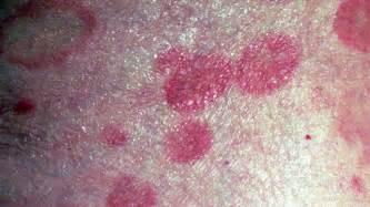 Skin Cancer Rash Itchiness And Symptoms