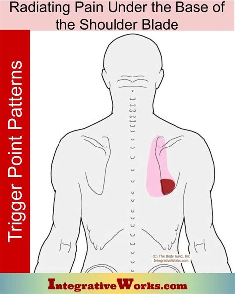 Pin On Upper Back Trigger Point Pain