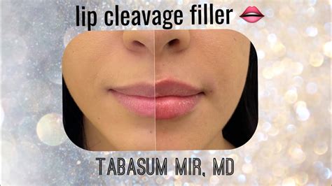 How To Create Lip Cleavage With Filler Youtube