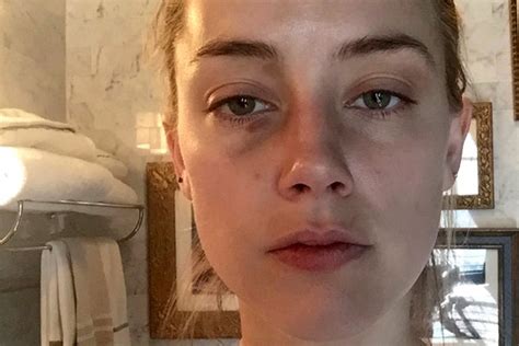 More Photos Of Amber Heards Bruised Face Released Page Six