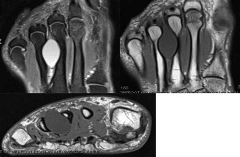 Osseous Remodeling Secondary To A Chronic Intermetatarsal Ganglion Cyst