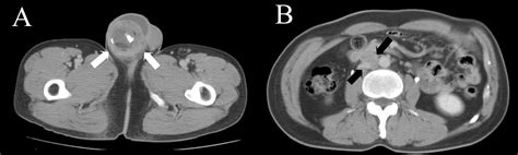 Signet ring cell-type adenocarcinoma arising in a mature teratoma of