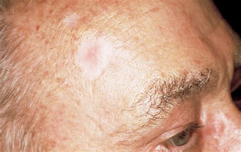 Pictures Of Skin Cancer On Your Forehead Picturemeta