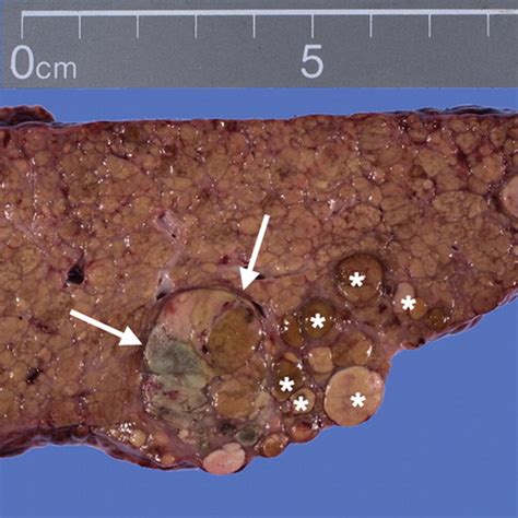 Cirrhosis Associated Hepatocellular Nodules Correlation Of