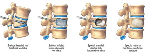 Kyphoplasty Explained Complete Spine And Pain Care