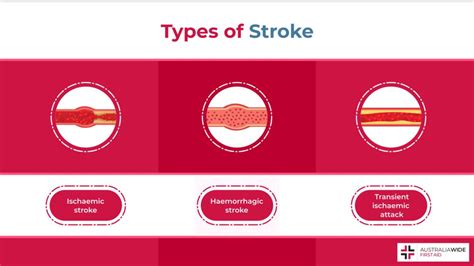 Different Types Of Stroke