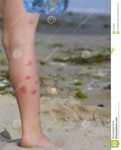Infected Skin From A Mosquito Stock Image Image Of Child Irritation