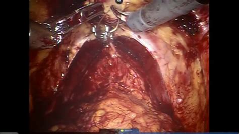 Dr Kaouk Step By Step Robotic Radical Prostatectomy Youtube