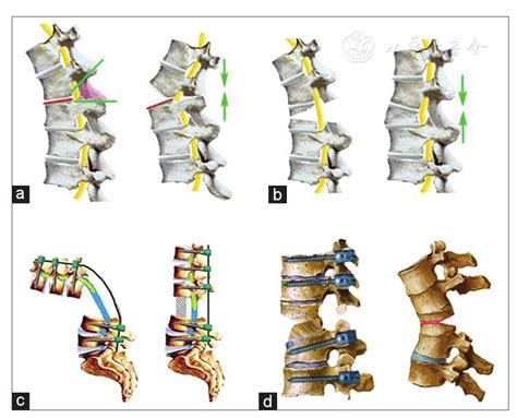 Osteotomy Techniques For Spinal Deformity Chinese Medical Journal