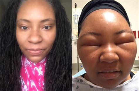 Health Vlogger Chemese Armstrongs Extreme Allergic Reaction To Henna