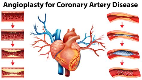 After receiving blood directly from the left ventricle of the heart, the. Diagram showing angioplasty for coronary artery disease - Download Free Vectors, Clipart ...